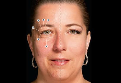 Corriger les paupières tombantes