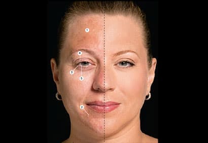 Peau grasse et rougeurs: astuces pour zéro défaut