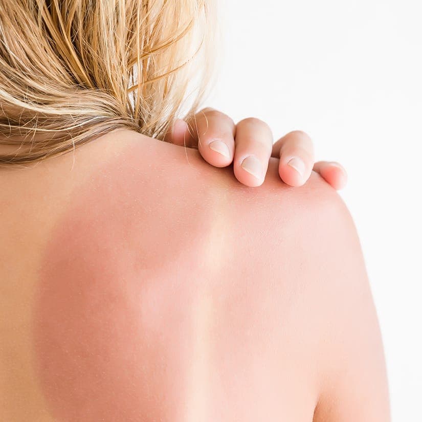 6 trucs pour soulager un coup de soleil