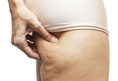 Trucs beauté: Mieux comprendre la cellulite