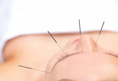 L'acupuncture contre la douleur